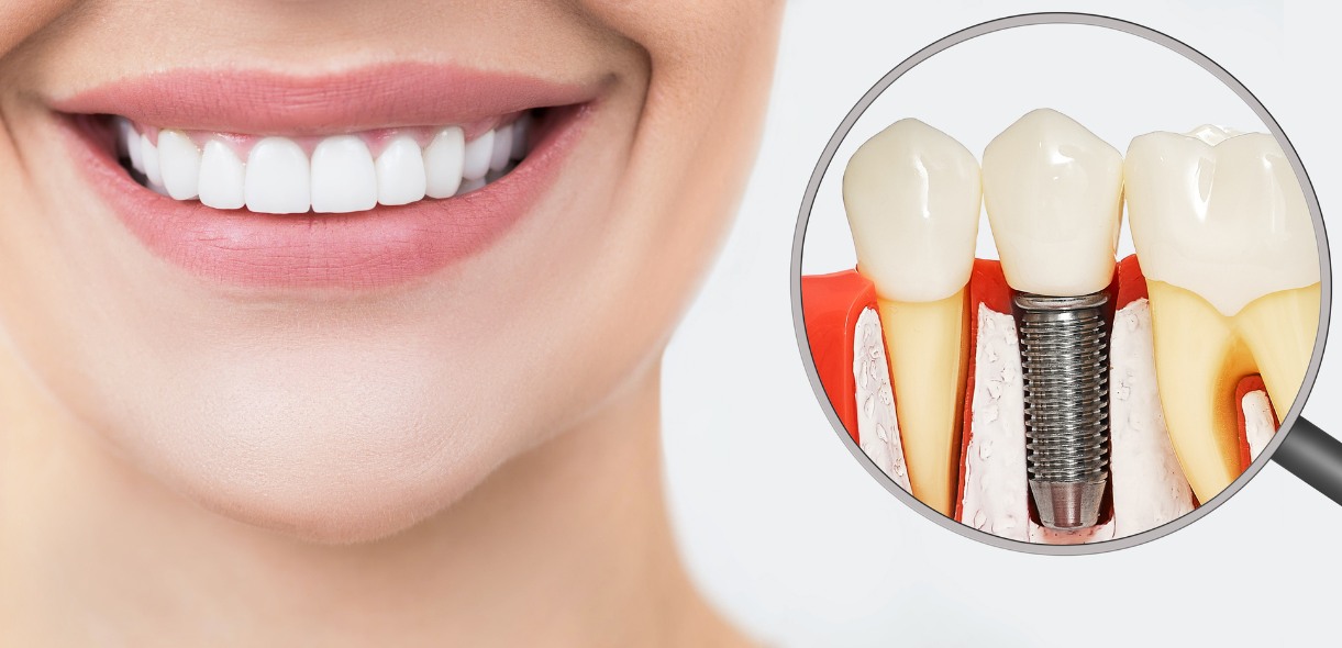 Top Benefits of Dental Implants - Media Hometown Dental
