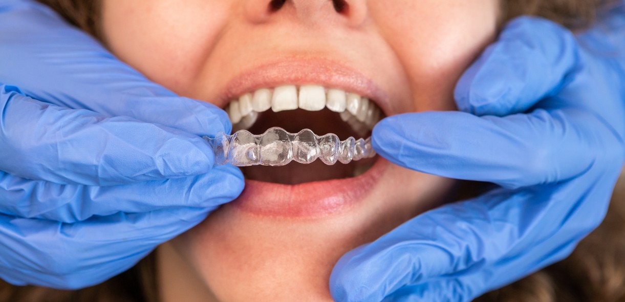 What to Expect During Your Invisalign Treatment in Media, PA - Media Hometown Dental