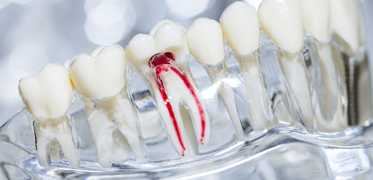 When a Root Canal Is Necessary