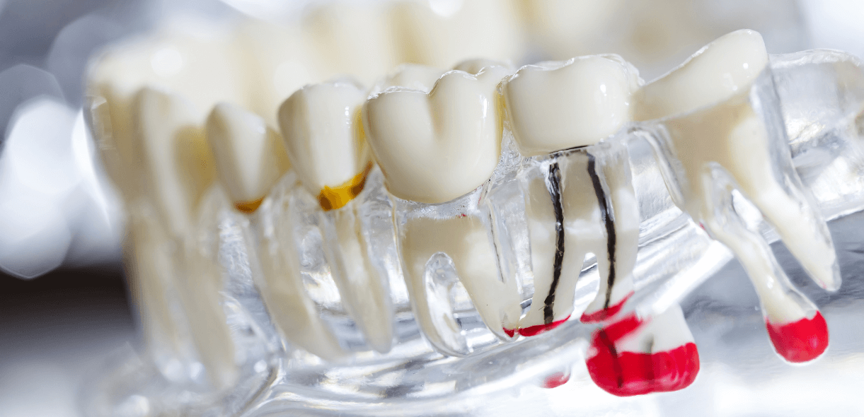 Can a Root Canal Procedure Save My Tooth?