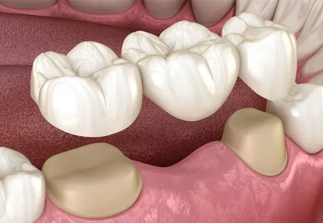 Dental Bridge in Media PA - Media Hometown Dental