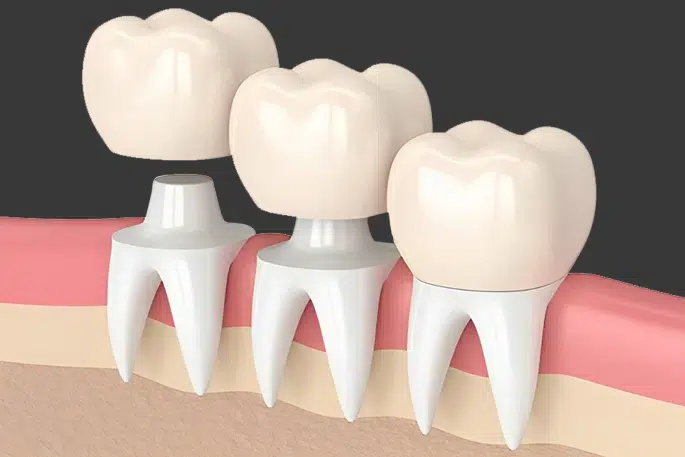 Dental Crown in Media PA - Media Hometown Dental
