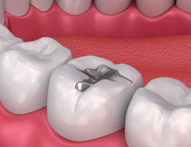 Dental Fillings in Media PA - Media Hometown Dental