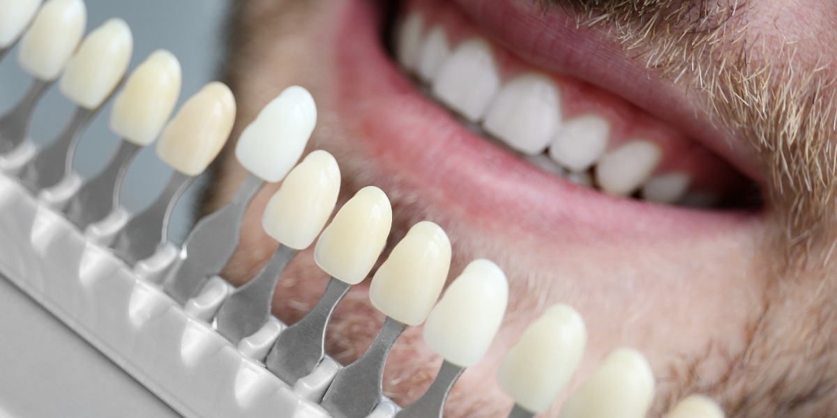 veneers straighten teeth just like braces