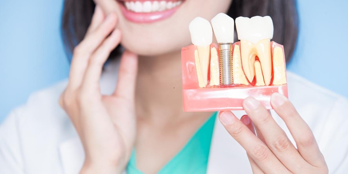 complete guide on dental implants