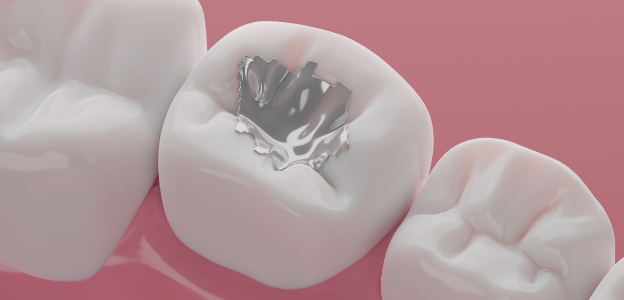Why Dental Fillings Are Essential for Long-Term Oral Care