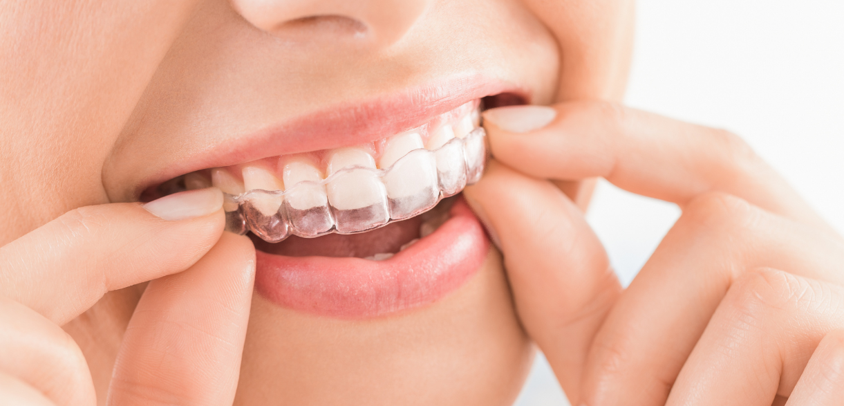 How To Care For Your Invisalign Aligners Properly?