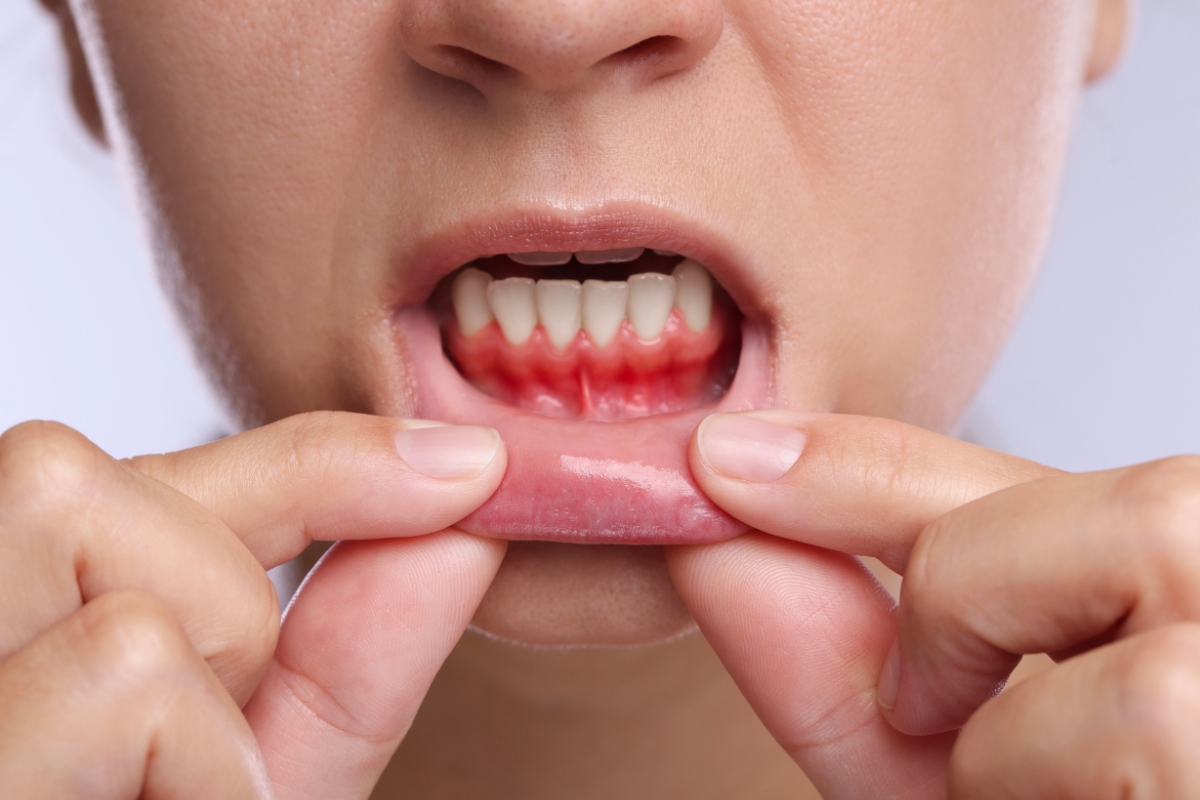 Gum-Disease-Treatment-PA